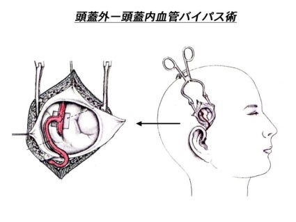 局所麻酔下頭蓋外-内血管バイパス術