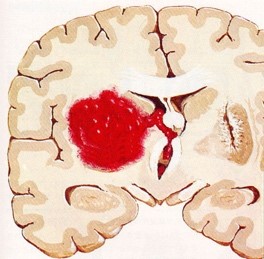 脳内出血