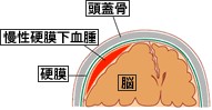 慢性硬膜下血腫