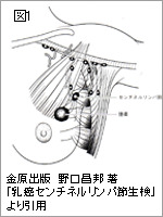 「センチネルリンパ節」(図1)