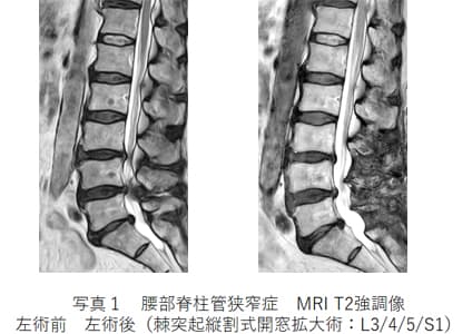 腰部脊柱管狭窄症　MRI T2強調像