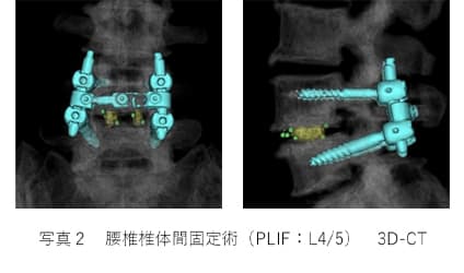 腰椎椎体間固定術（PLIF：L4/5）