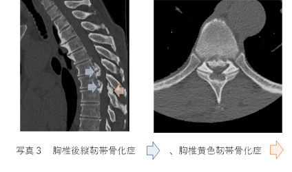 胸椎後縦靭帯骨化症、胸椎黄色靭帯骨化症