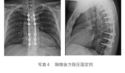 胸椎後方除圧固定術