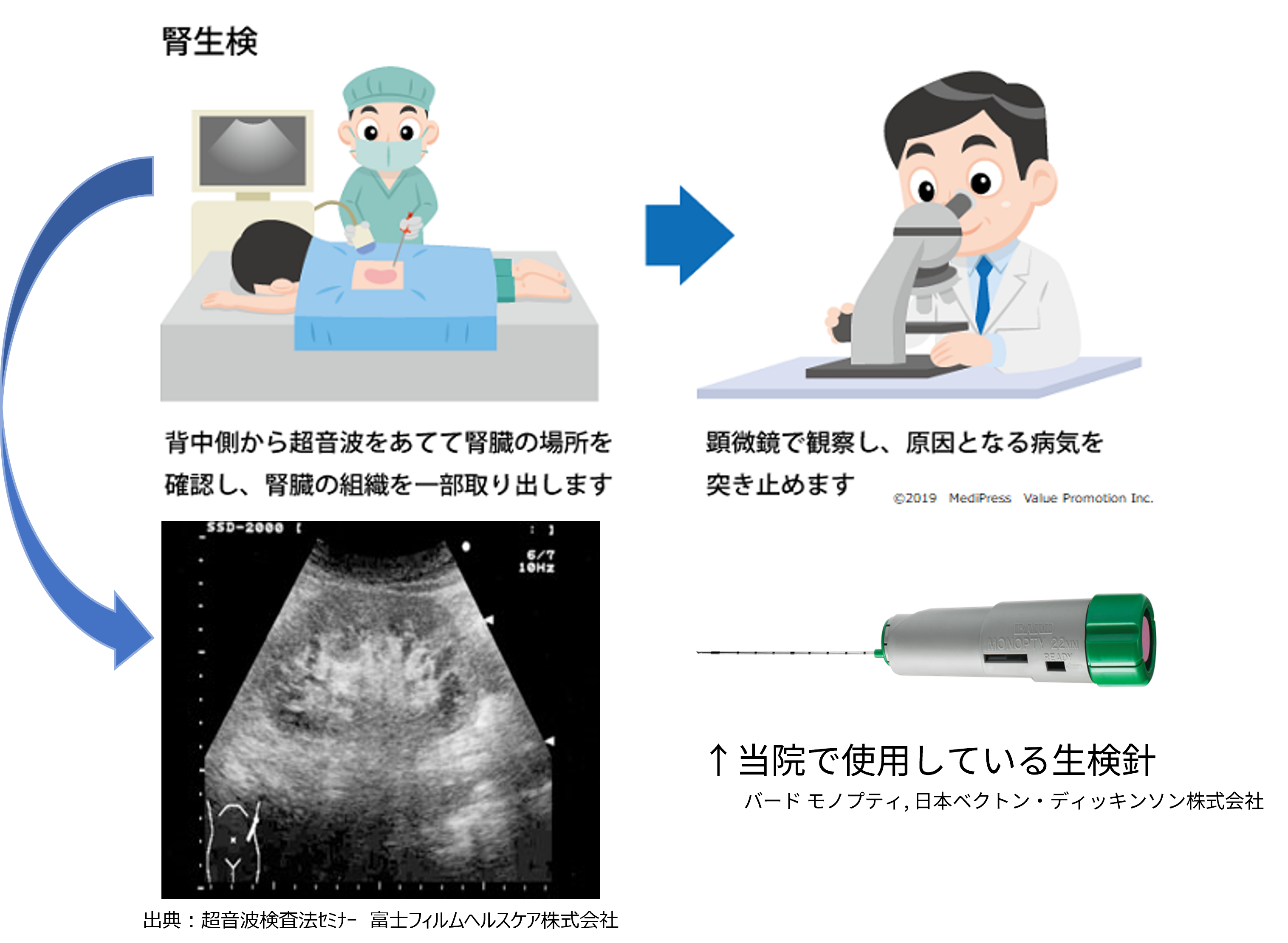 IgA腎症・糸球体腎炎・ネフローゼ症候群　イメージ