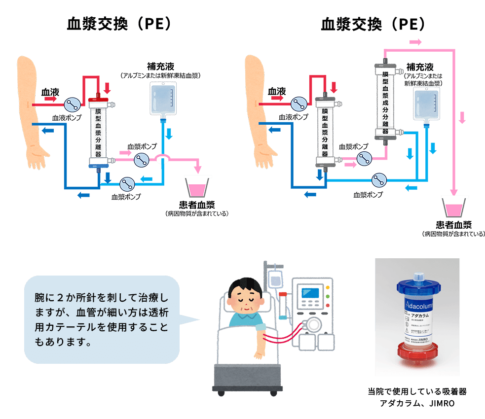 その他の血液浄化療法イメージ