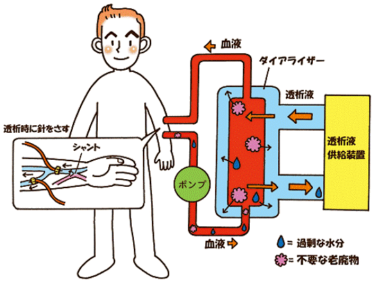 血液透析（HD）・血液濾過透析（HDF）図解