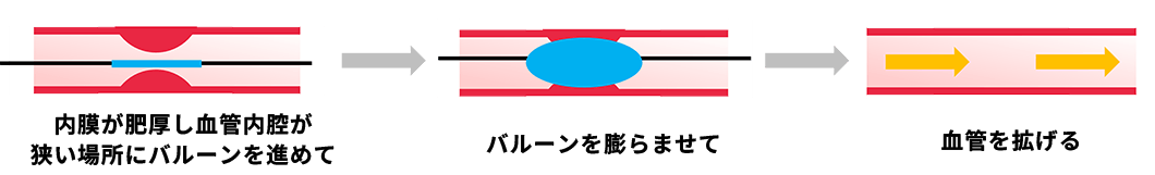 内シャントPTA（経皮的血管拡張術）　図解