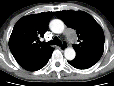 CT写真（肺がん）